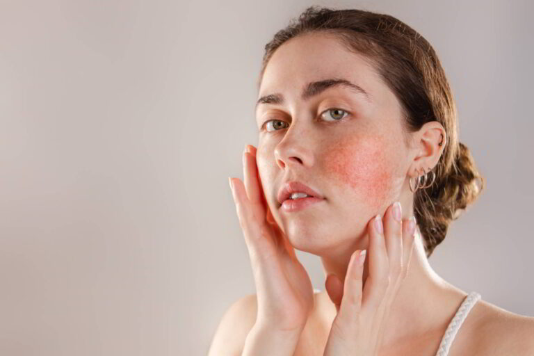 Woman holding her red cheeks because of rosacea